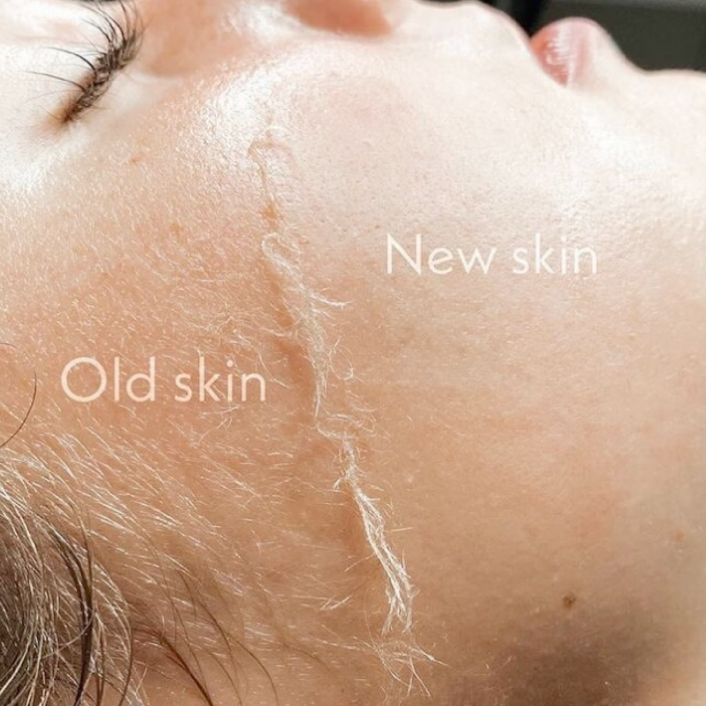 Dermaplaning Course