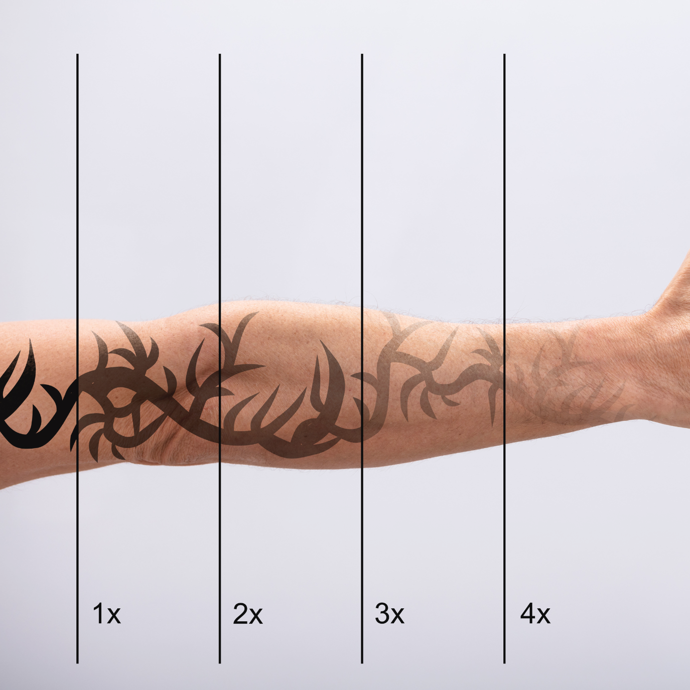 Laser Tattoo Removal Course COMING 2026