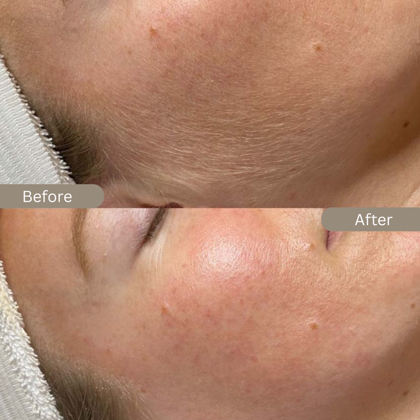 Dermaplaning Course