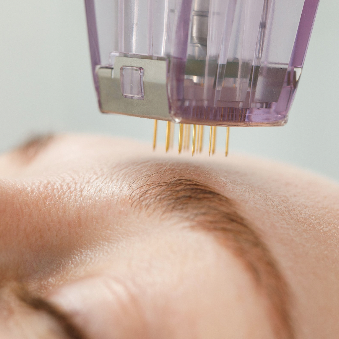 RF Microneedling Course COMING SOON IN MAY 2026